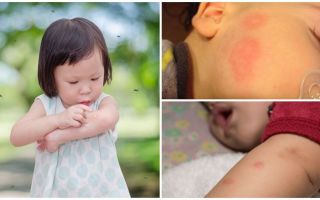 Punture di zanzara sulla pelle di un adulto o di un bambino