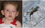 Què fer si un nen té un ull inflat després d'una picada de mosquit