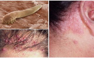 Simptomele și tratamentul acarianului de păr la om