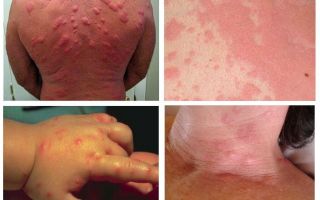 Réaction allergique aux piqûres de punaises de lit