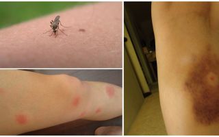 Perché i lividi rimangono dopo le punture di zanzara?