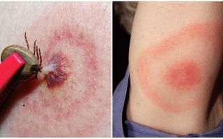 Qual è la malattia di Lyme, i suoi sintomi, il trattamento e la foto