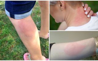 Tratamentul alergiilor la mușcăturile de țânțari la adulți și copii