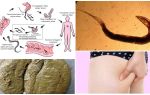 Как изглеждат червеите в изпражненията