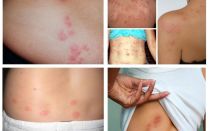 Hoe zien bedbugbeten eruit op de menselijke huid?