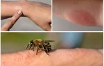 Phản ứng dị ứng với ong chích, phải làm gì