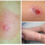 Алергия срещу хлебарки