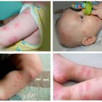 Picadas de pulgas em uma criança