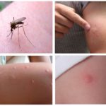 Punture di zanzara