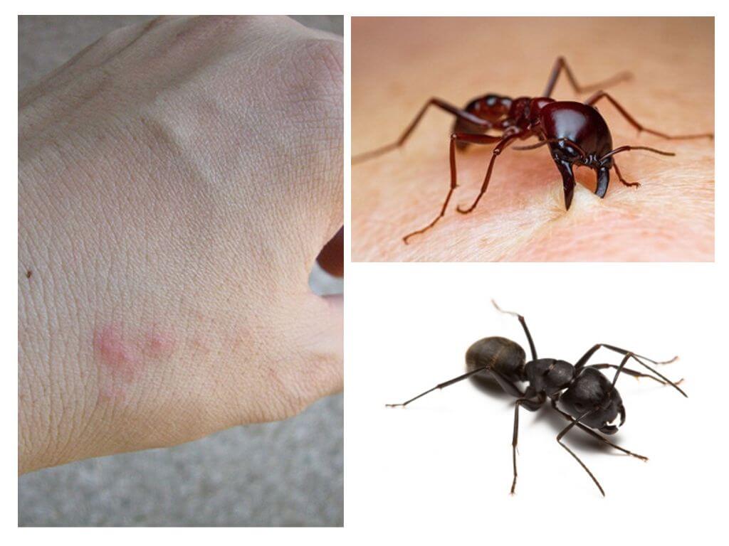 Morsure de fourmi