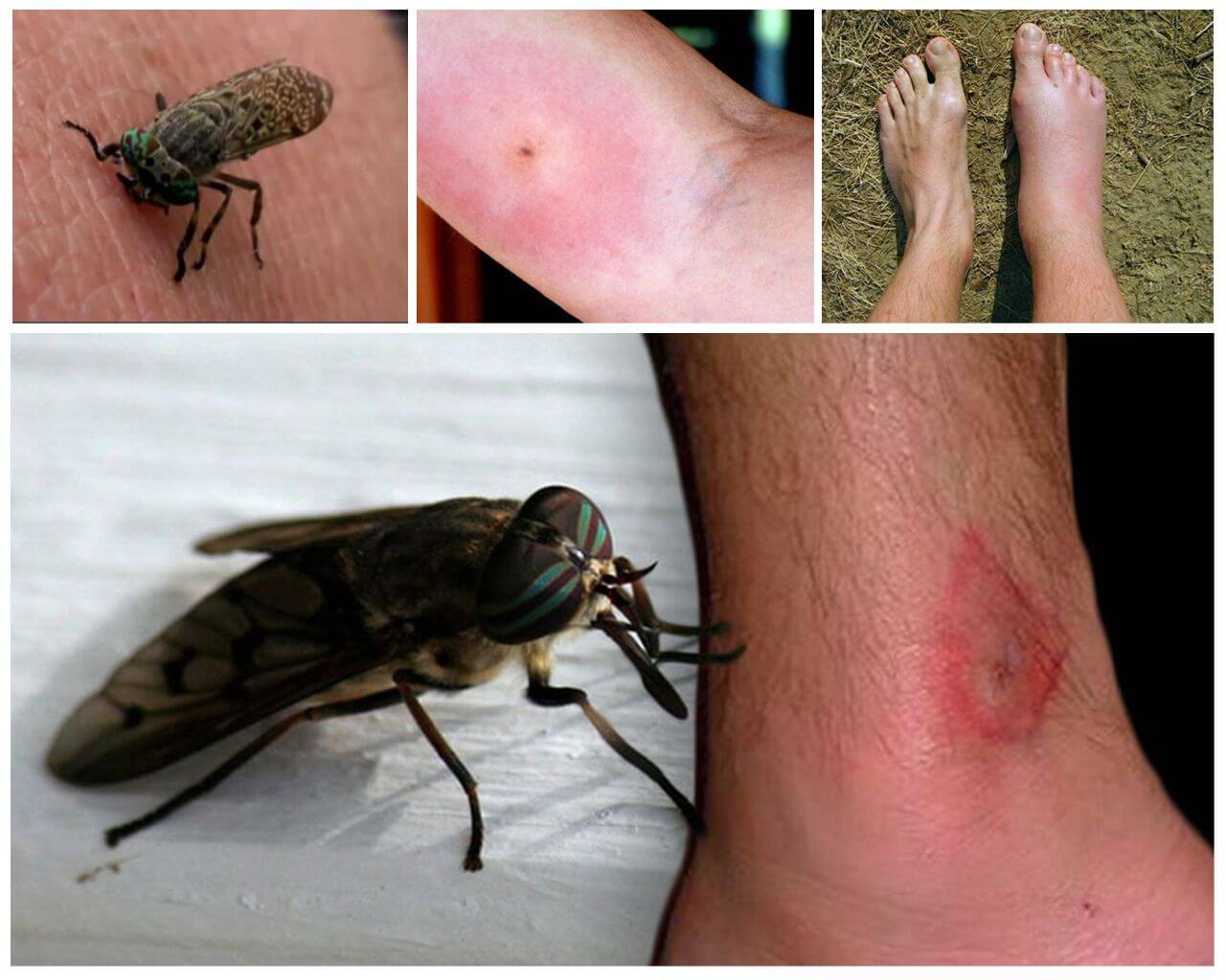 Insektbit på människokroppen