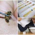 Điều trị nọc độc ong