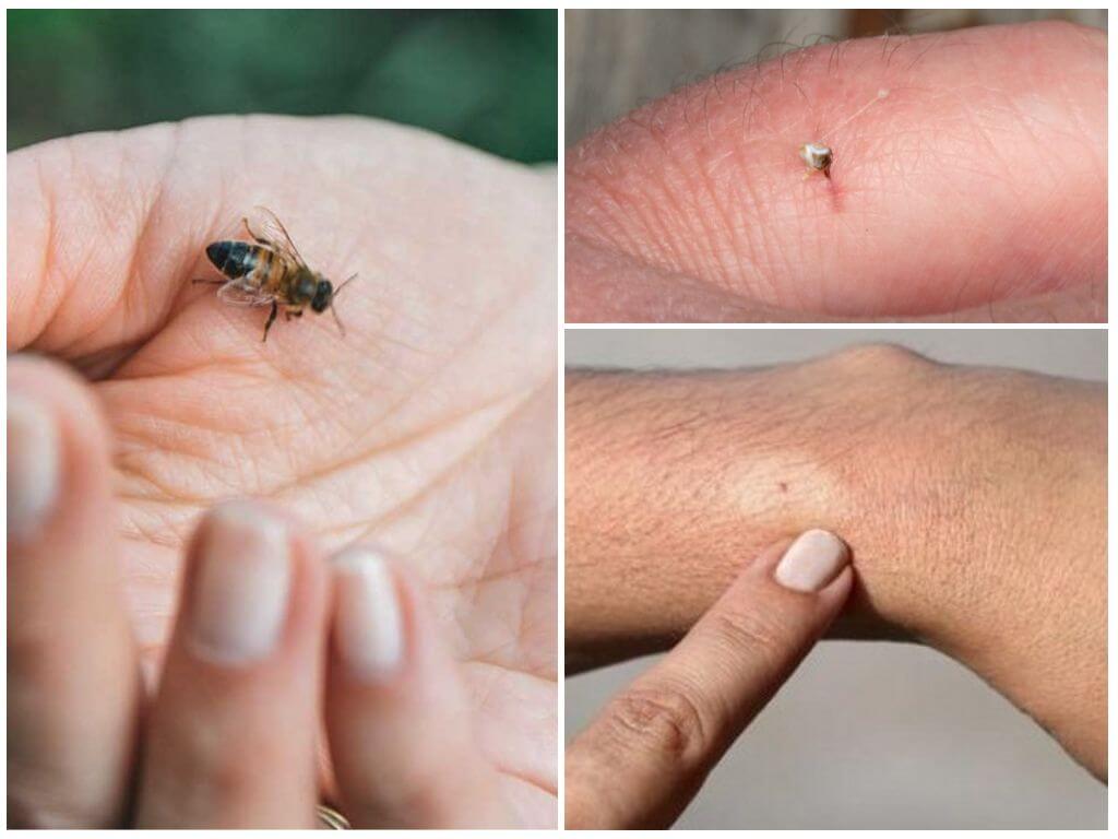 Bee, vết cắn của nó và sting
