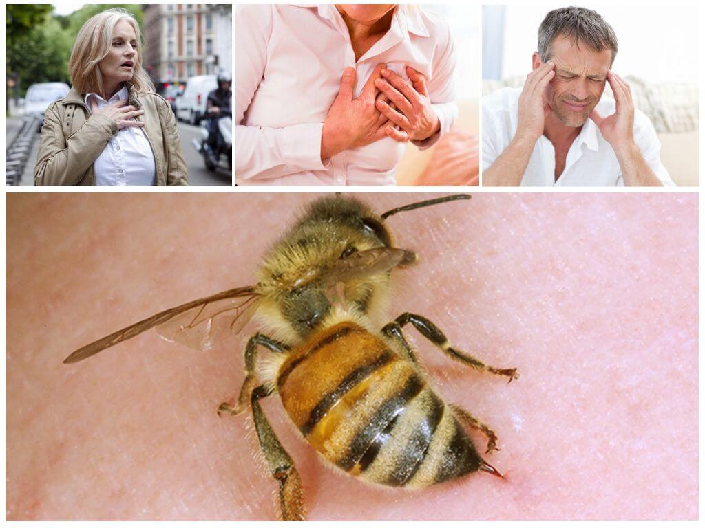 Những ảnh hưởng của một con ong sting