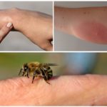 Picadura de abeja y alergia a ella