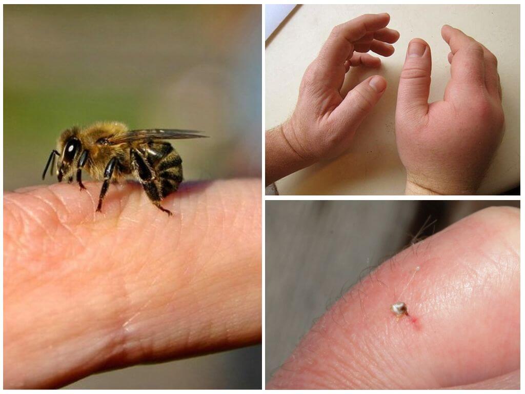 Tác hại từ ong sting