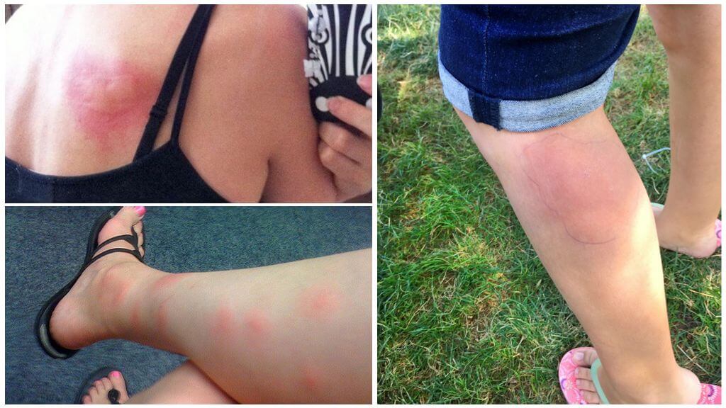 Алергична реакция към ухапвания от комари