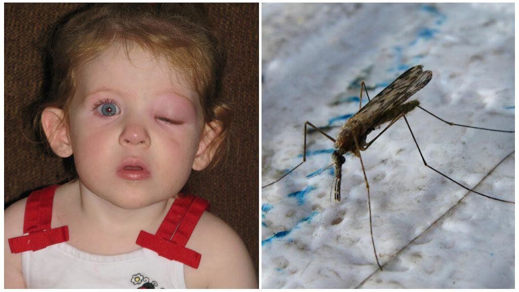 Svullna ögon hos ett barn från en myggbett