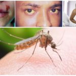 Les possibles conseqüències d’una mossegada de mosquits