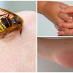 Allergische Reaktion auf Wespenstich
