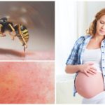 Wespenbiss während der Schwangerschaft