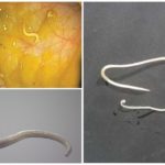 Pinworms की उपस्थिति