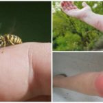 Wasp sting